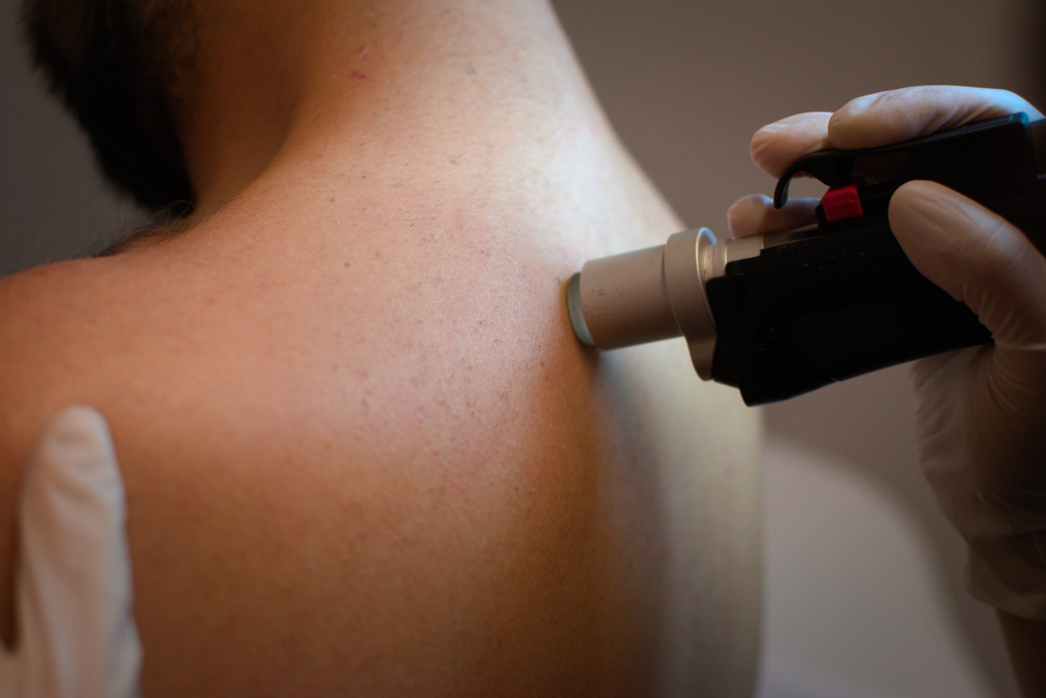 Laser αποτρίχωση στο Medical Skin Care